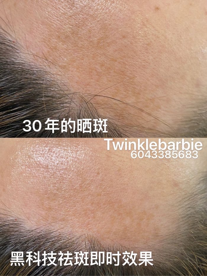 黑科技祛斑：30年晒斑前后对比